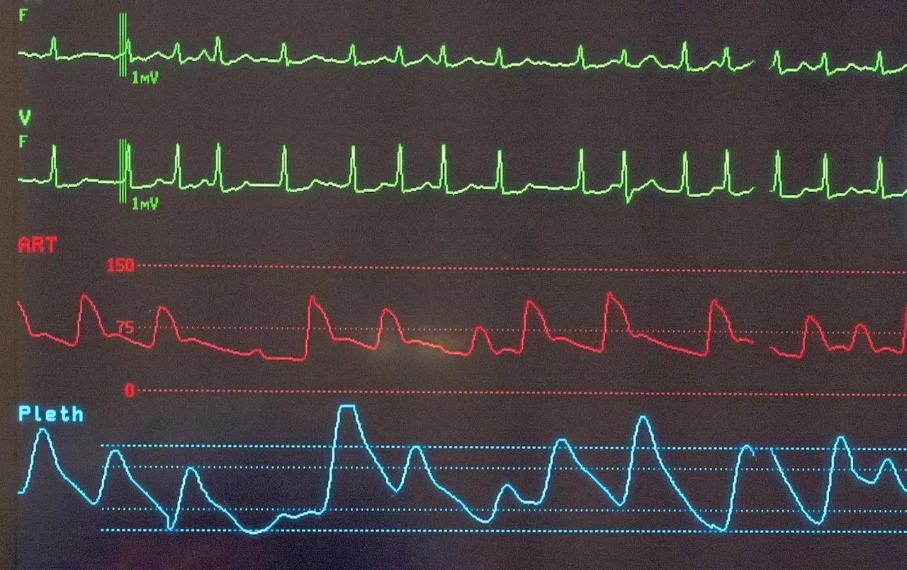 Atrial fibrillation: Treating a fluttering heart