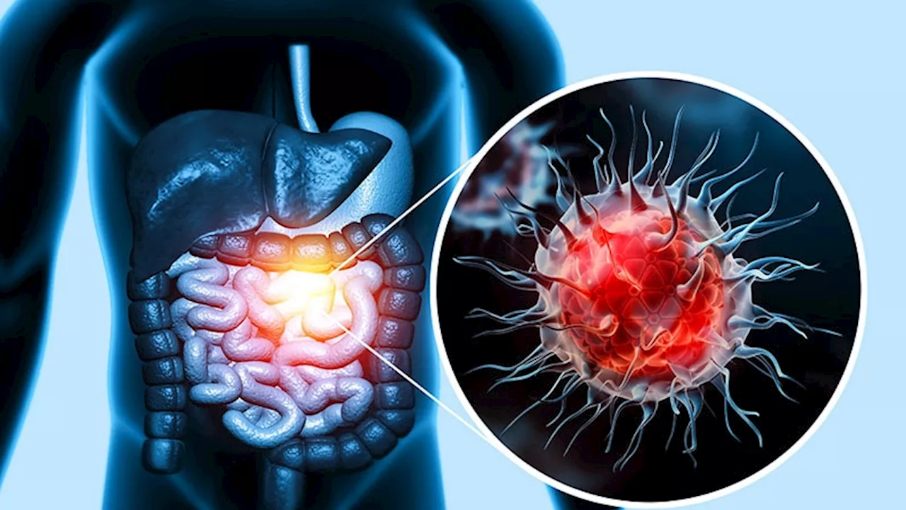 Adjuvant Atezolizumab + Chemo Improves Colon Cancer Survival