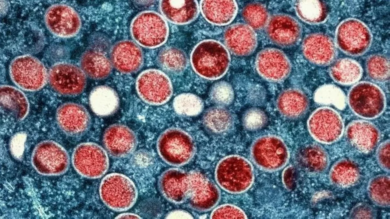 11 HIV patients from Davao test positive for mpox