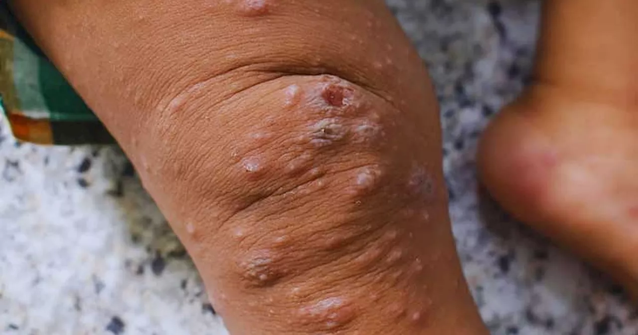 7 sa 11 dunay HIV takdan sab og mpox