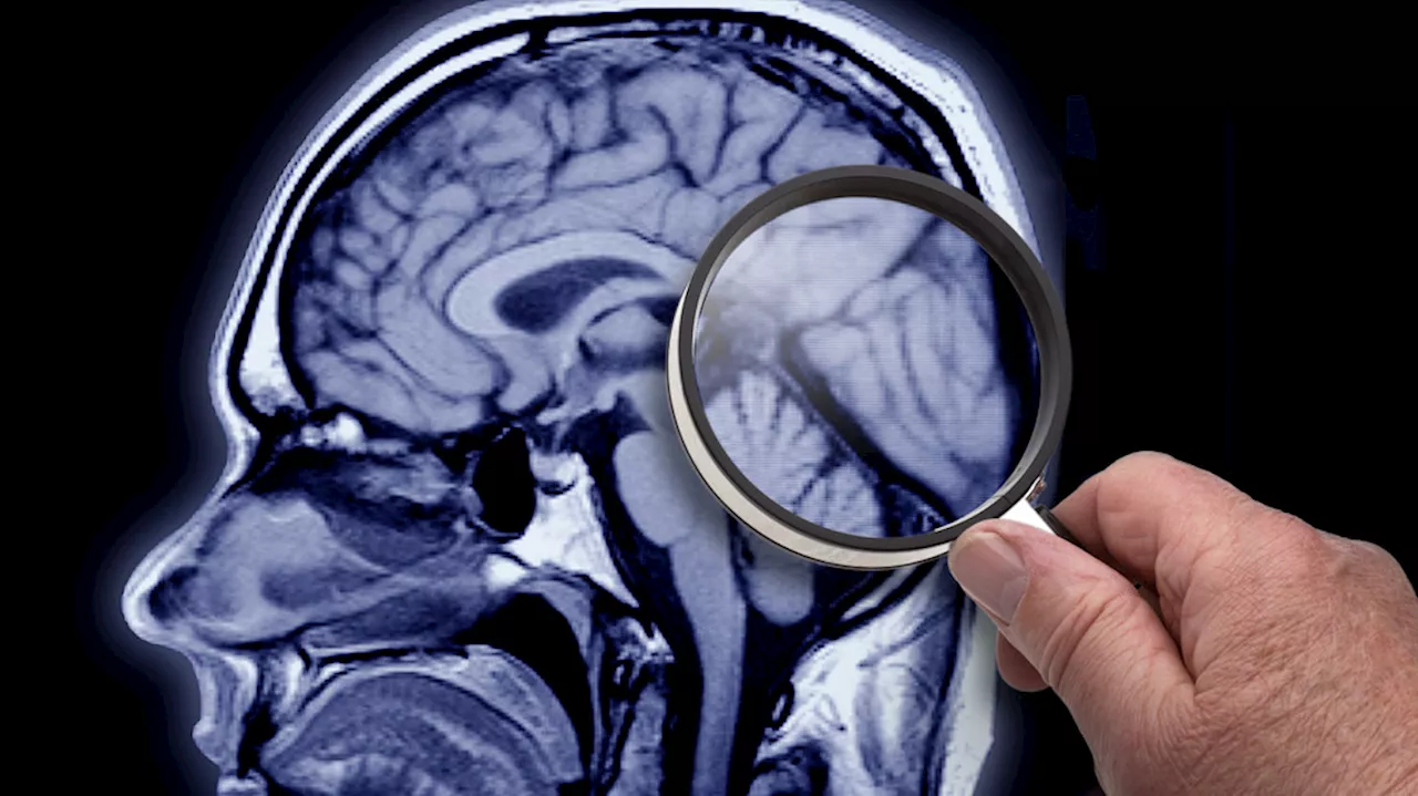 Health experts reflect on new FDA-approved Alzheimer's blood test