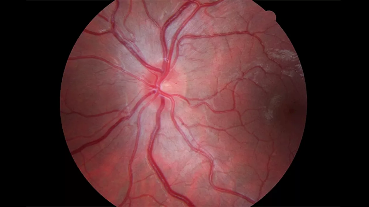 Rare Yet Alarming: US Study Maps Syphilitic Uveitis Trends