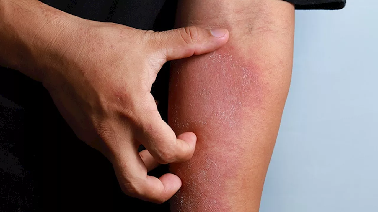 Dupilumab Treatment Linked to Weight Gain in Patients With Atopic Dermatitis