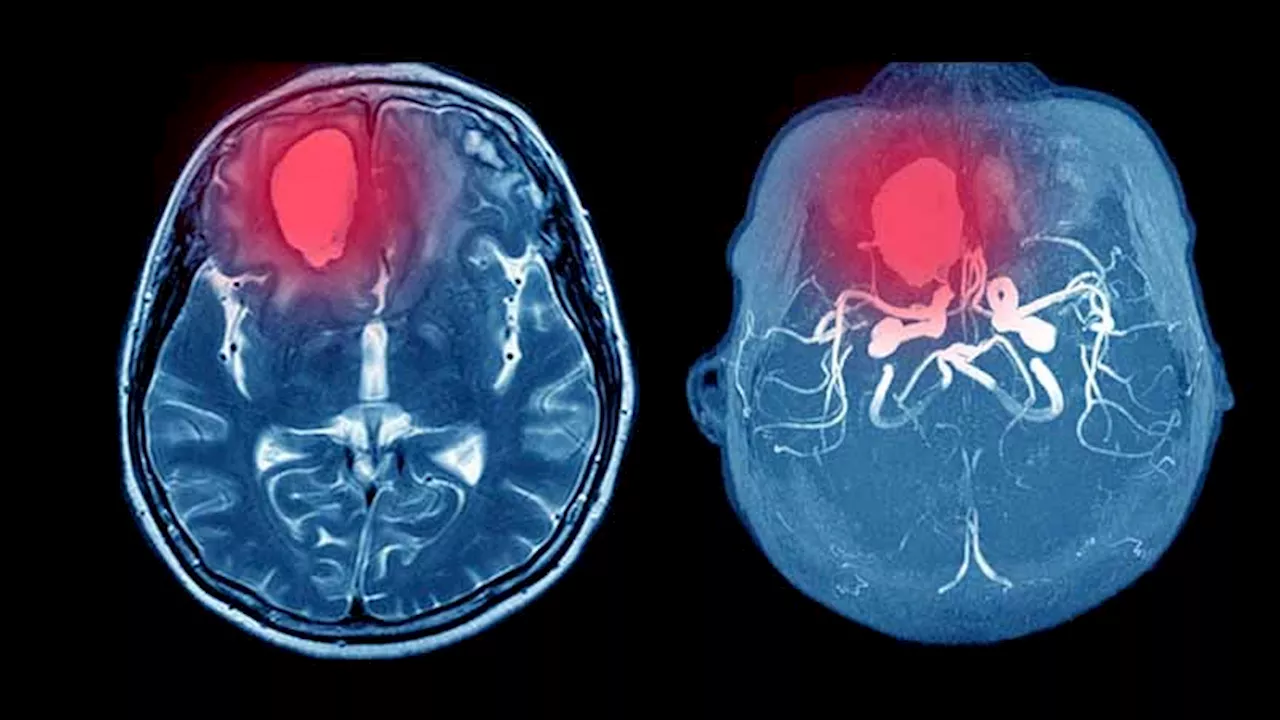 APOE4 May Raise Brain Bleed Risk in Apixaban Users With AF