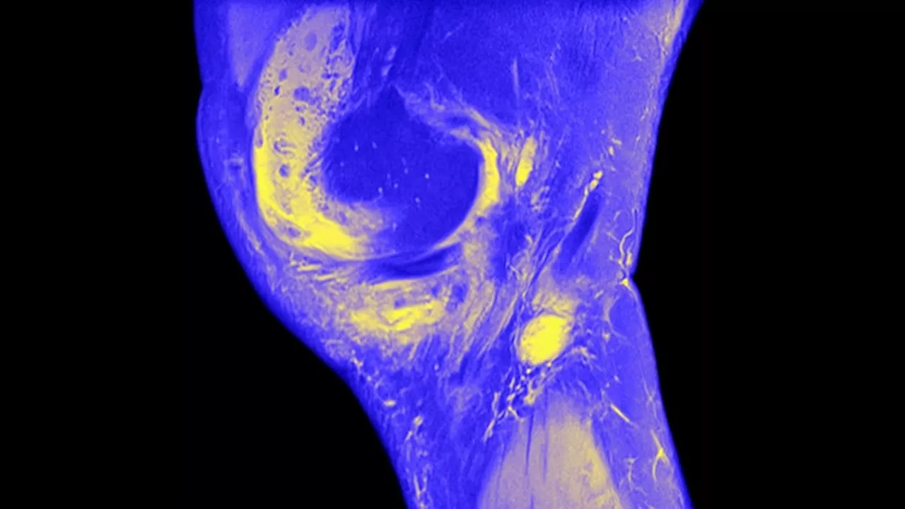 Meta-Analysis: Imaging Detects Synovitis in Psoriasis Without PsA
