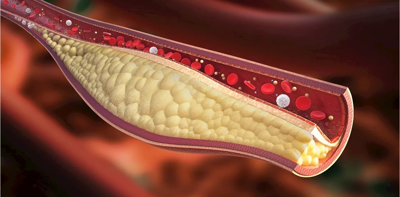 ¿No era el colesterol?: hallan una molécula en el intestino que puede cambiar la forma de tratar la ateroesclerosis