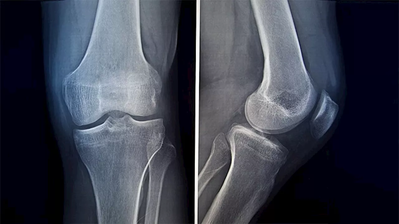 Can Artificial Intelligence Aid Fracture Detection in Children With Osteogenesis Imperfecta?
