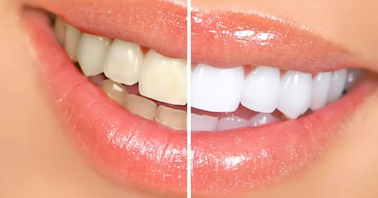 La mezcla mágica que ayuda a quitar el sarro de los dientes de forma definitiva