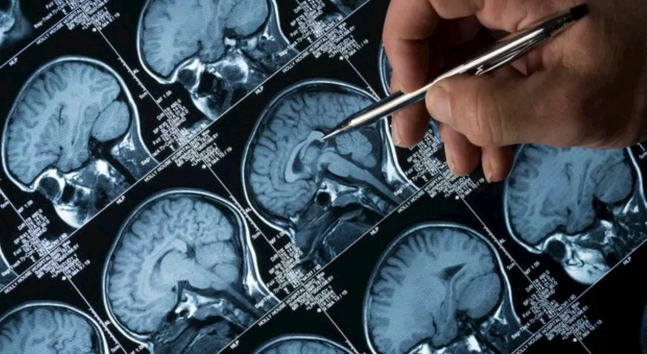 Alzheimer e Parkinson, scoperte le spie molecolari. «Permettono diagnosi precoci». Lo studio record su 35mila