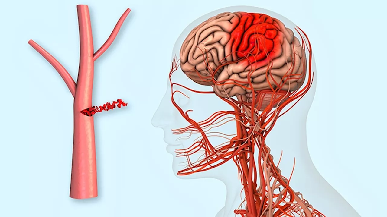 Anticoagulants in Atrial Fibrillation Post-Intracranial Hemorrhage: The Dilemma Continues