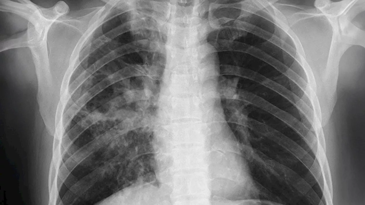 A Puzzling Pneumothorax in a 36-Year-Old Woman