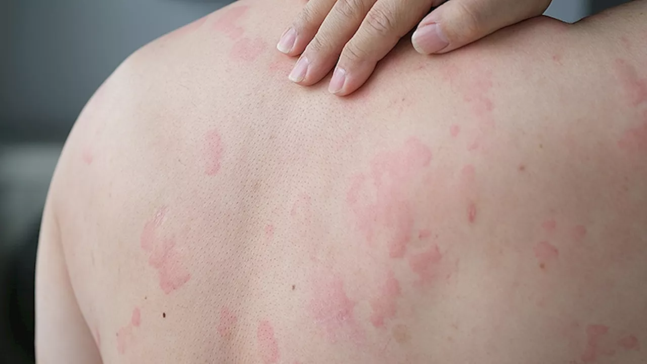 Top 3 Chronic Urticaria Treatments Highlighted in Meta-Analysis