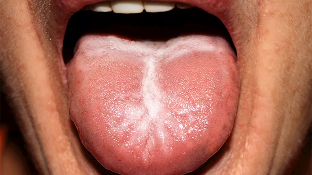Study Pinpoints How Dual IL-17A/F Blockade Heightens Candidiasis Risk