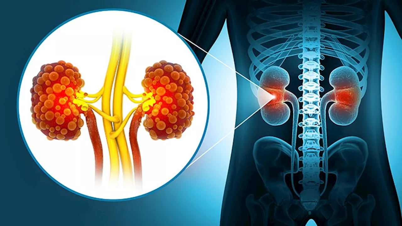 Hydroxychloroquine Use May Be Beneficial in Lupus Nephritis