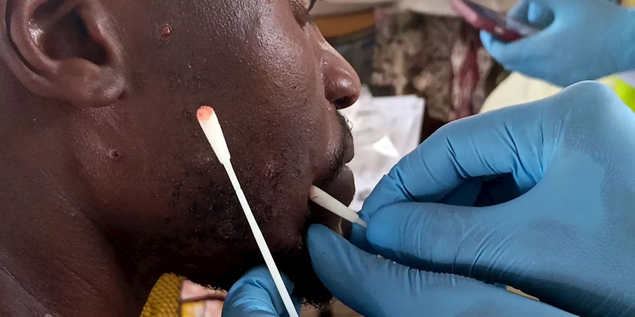 Gefährliches Virus: Mpox kann laut Studien das Gehirn befallen
