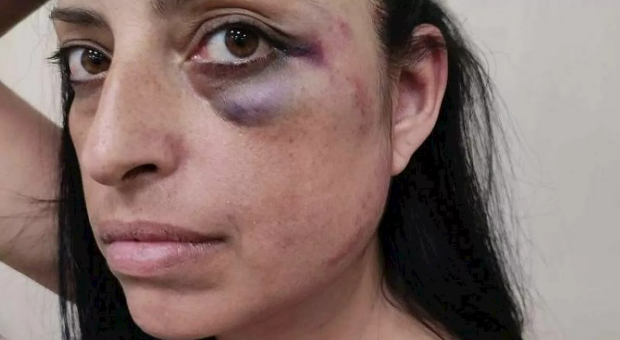 Massacrata di botte dal fidanzato 18enne della figlia, Anna Chiara costretta a fuggire: «Mi ha presa a pugni in faccia, poi mi ha...