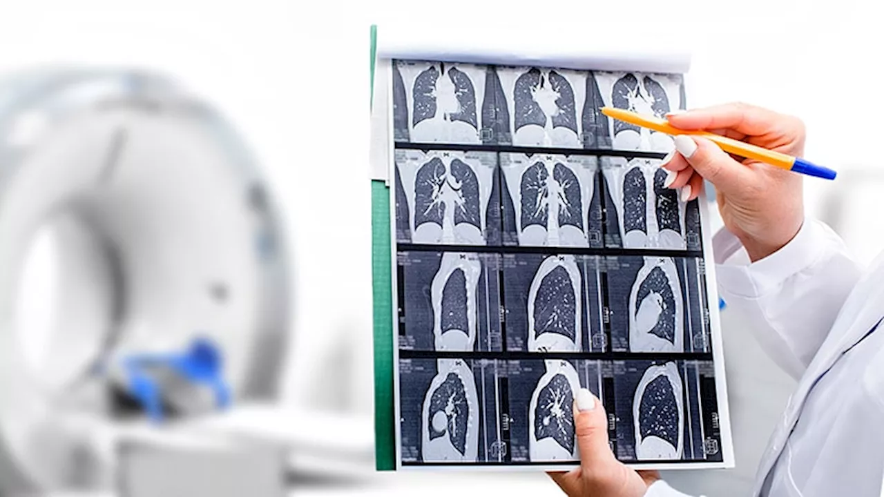 Australia Launches Lung Cancer Screening Program for Smokers