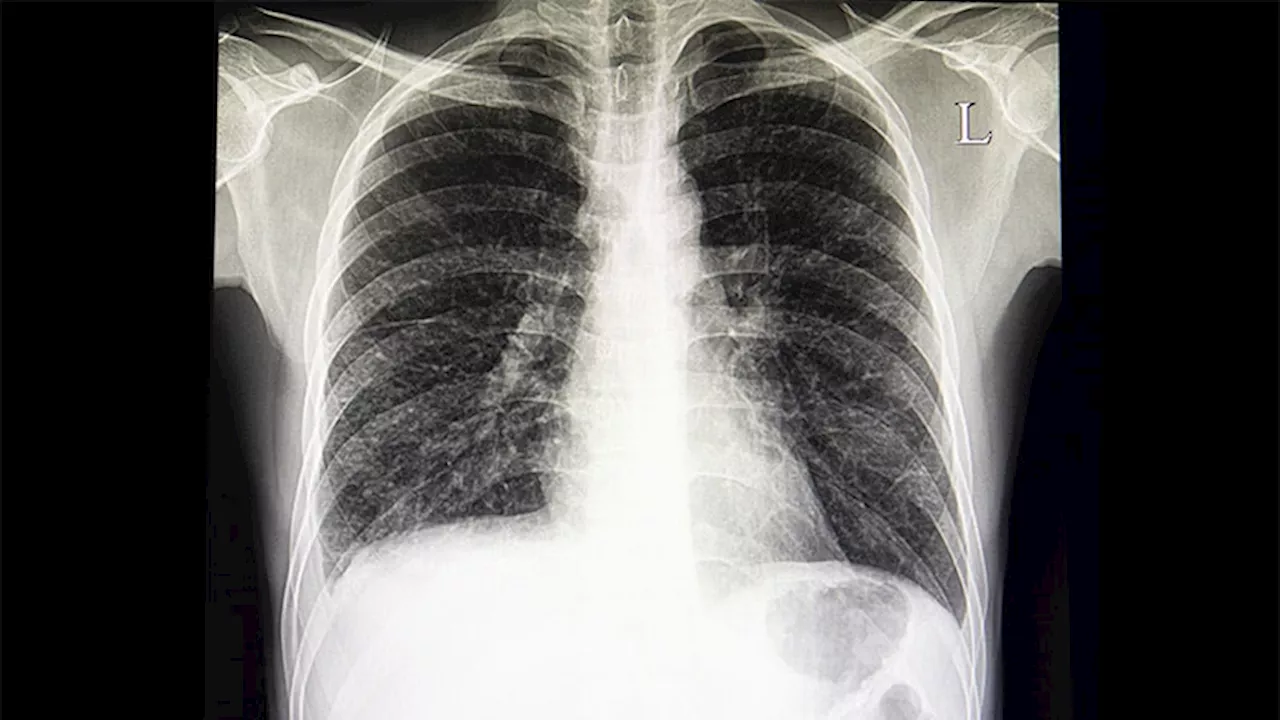 IBD Linked to Higher Risk for Interstitial Lung Disease