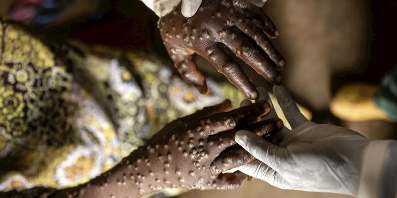 Mpox: Neue Variante führt zu wachsenden Pandemie-Sorgen