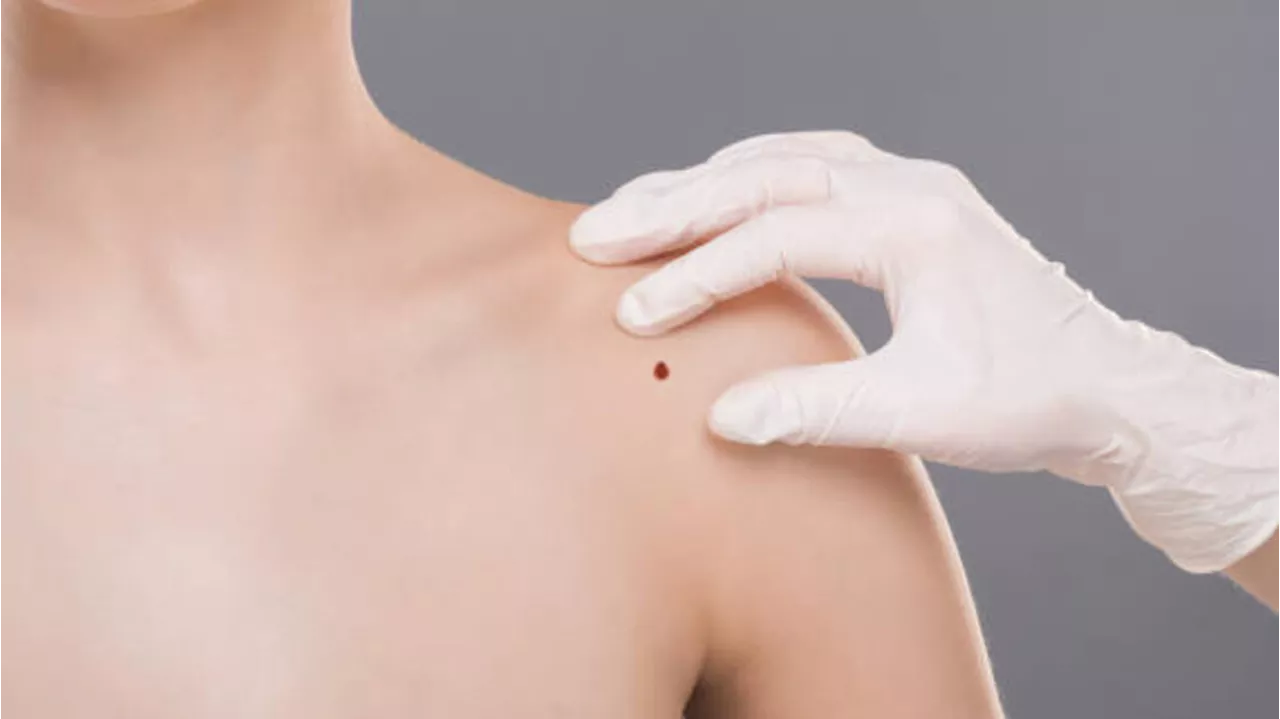 La mappatura dei nei non è sparita, 'è nella visita dermatologica'