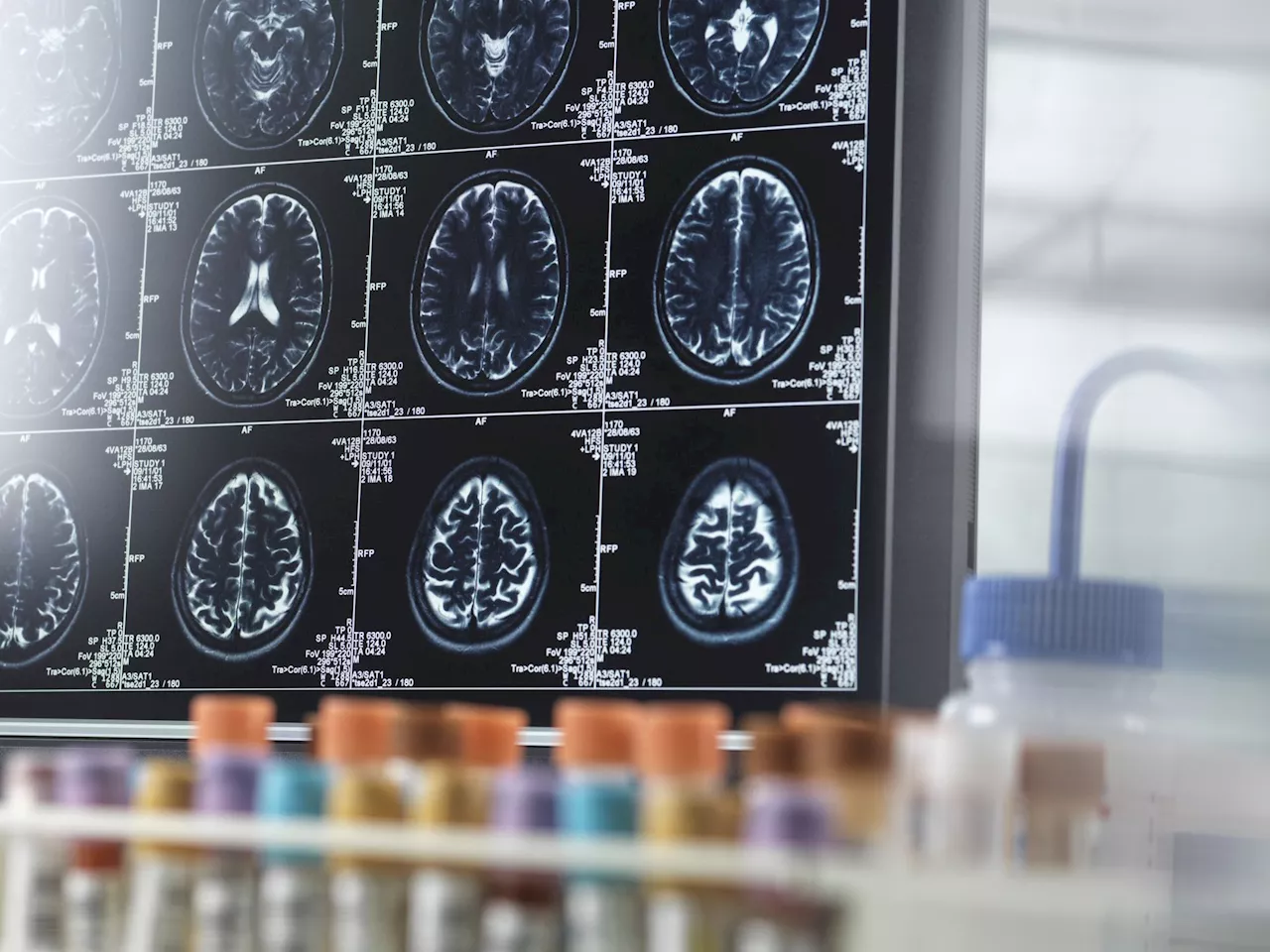Lítio pode ser chave para desvendar mistérios do Alzheimer, revela estudo