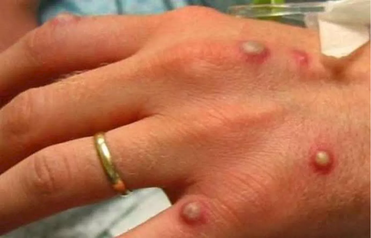 Kaduna to begin monkeypox vaccination in affected LGAs