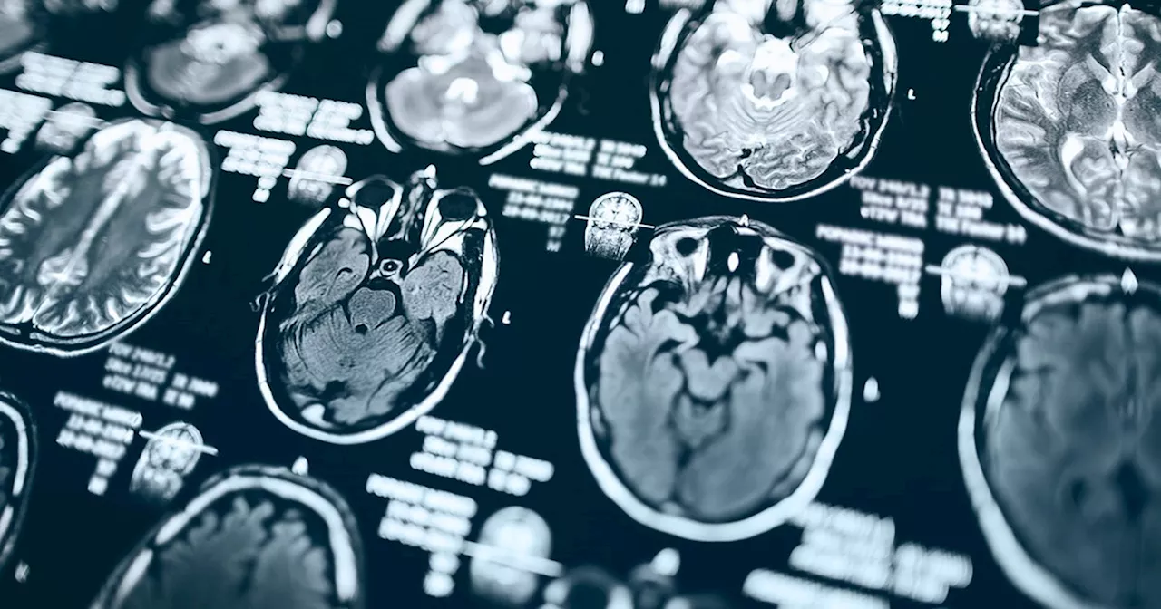 Kidney disease may trigger rare, potentially fatal brain virus, study says